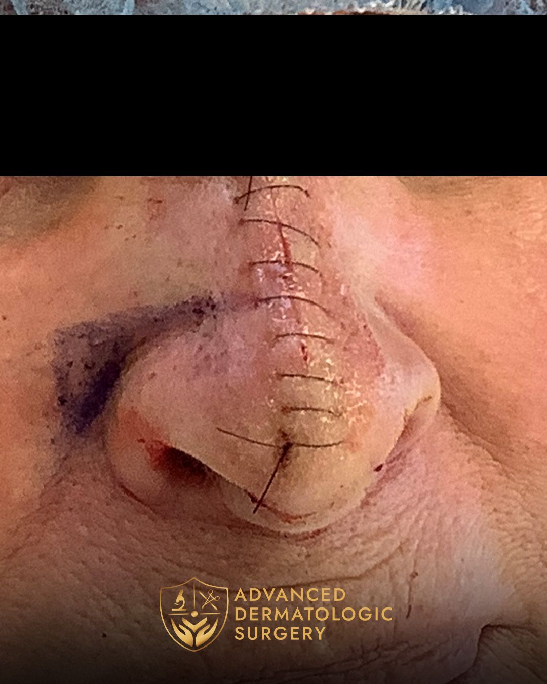 Close up of a woman's nose after reconstruction surgery