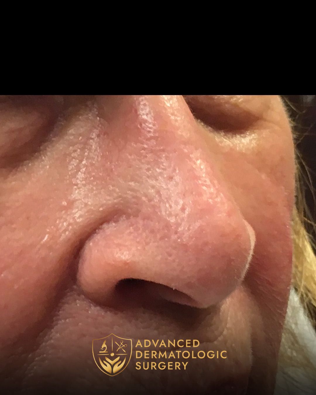Close up of a woman's nose after fully healing from surgery