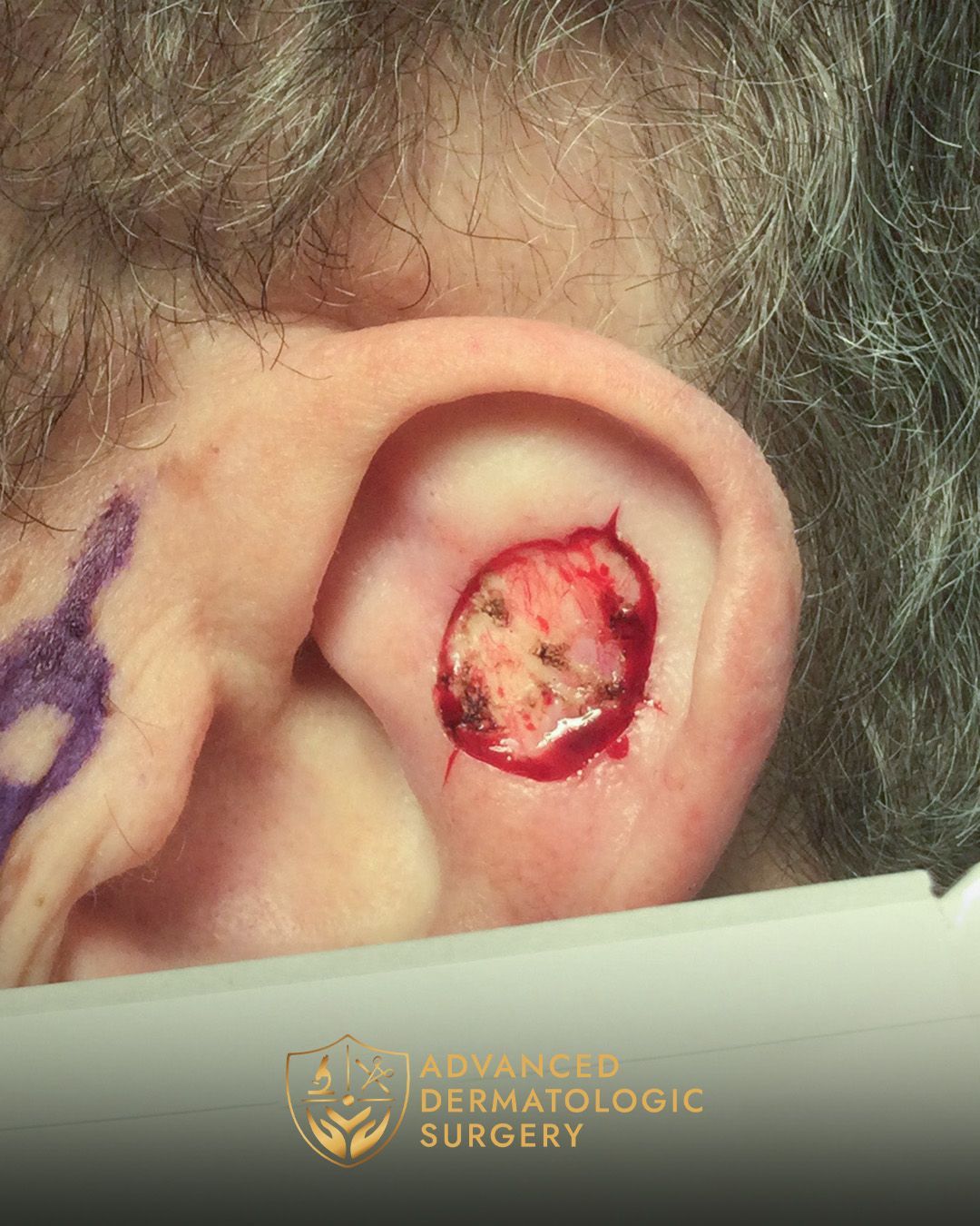 Close up of a man's left ear after MOHS