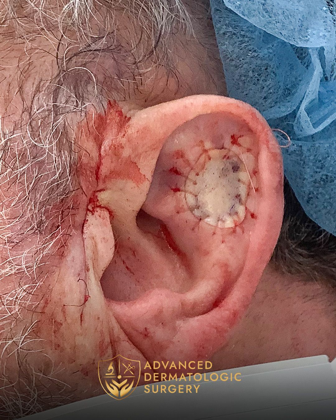 Close up of a man's ear after reconstruction surgery