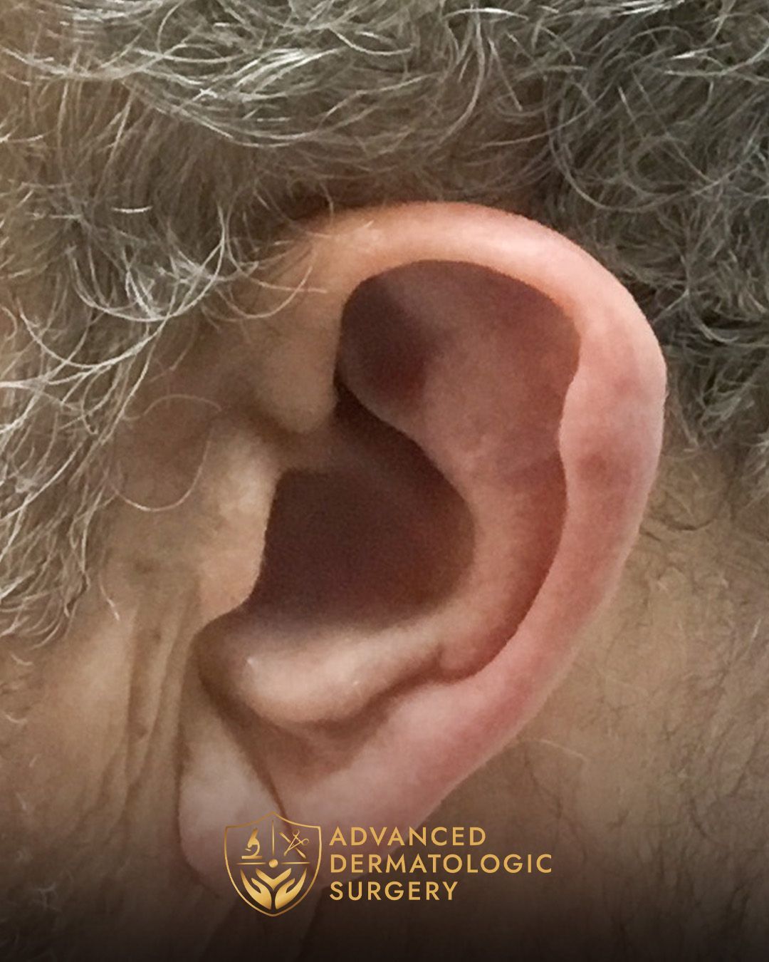 Close up of a man's ear after fully healing