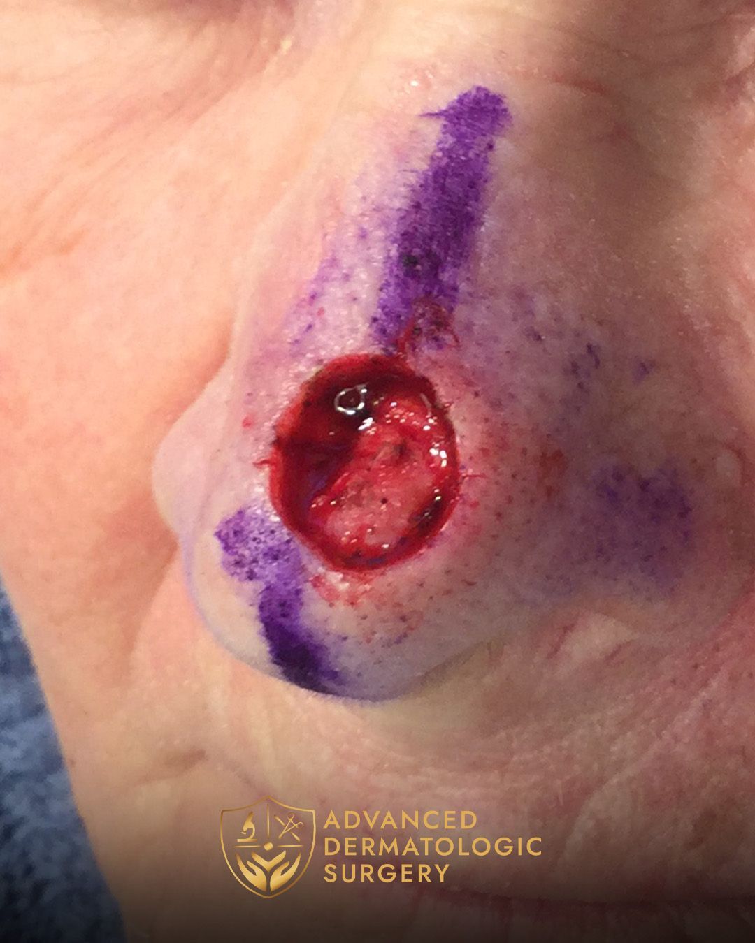 Close up of a woman's nose after Mohs surgery