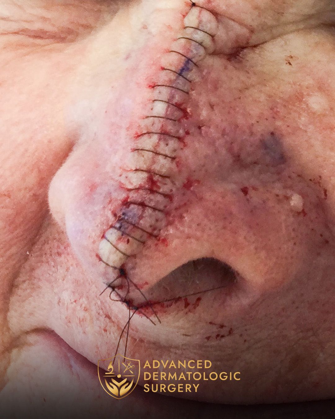 Close up of a woman's nose after reconstruction surgery