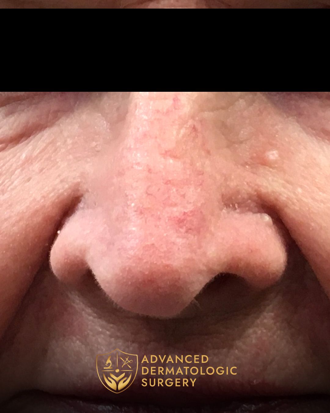 Close up of a woman's nose after fully healing
