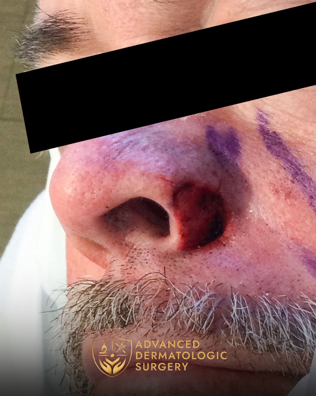 Close up of a man's nose after MOHS
