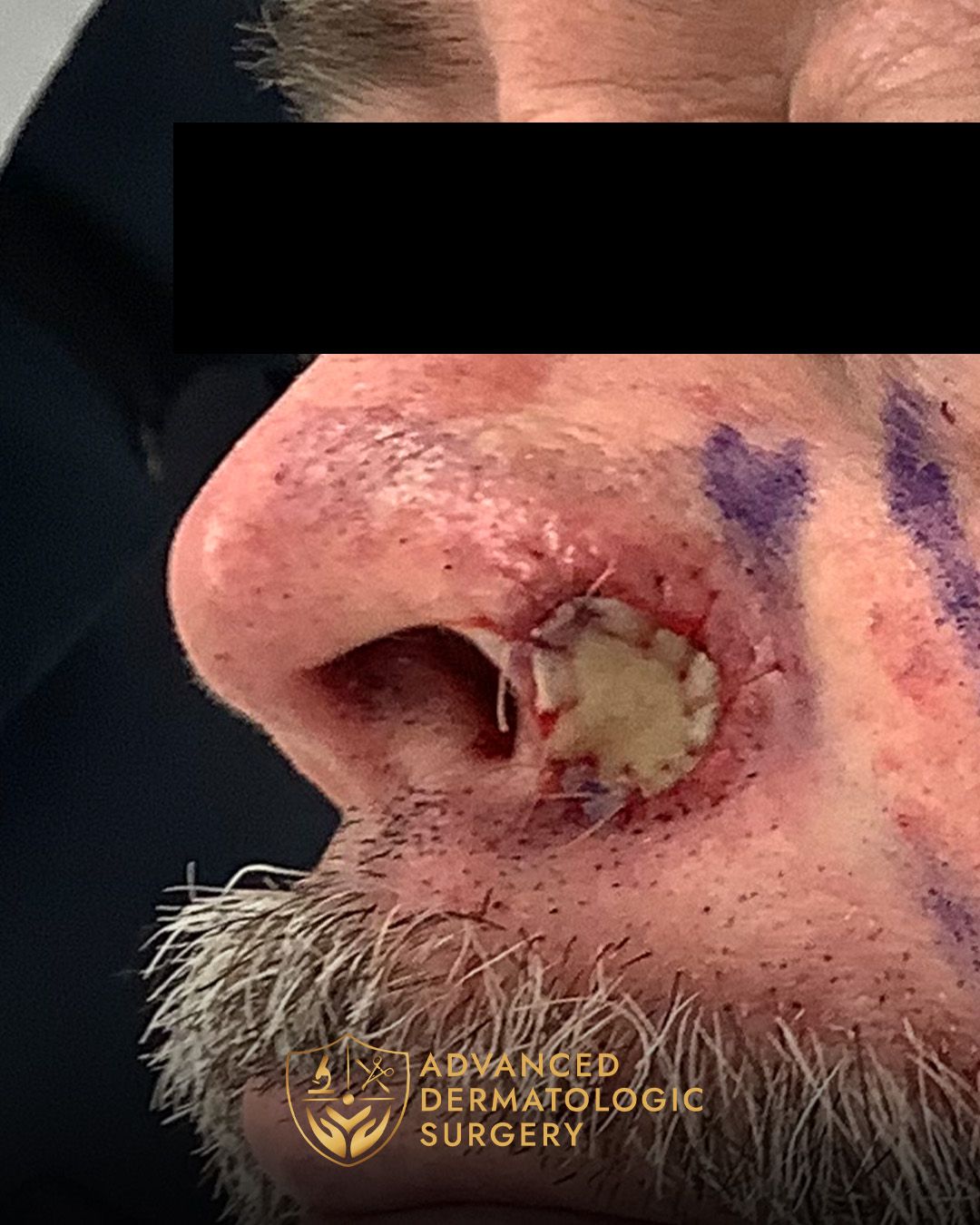 Close up of a man's nose after reconstruction surgery