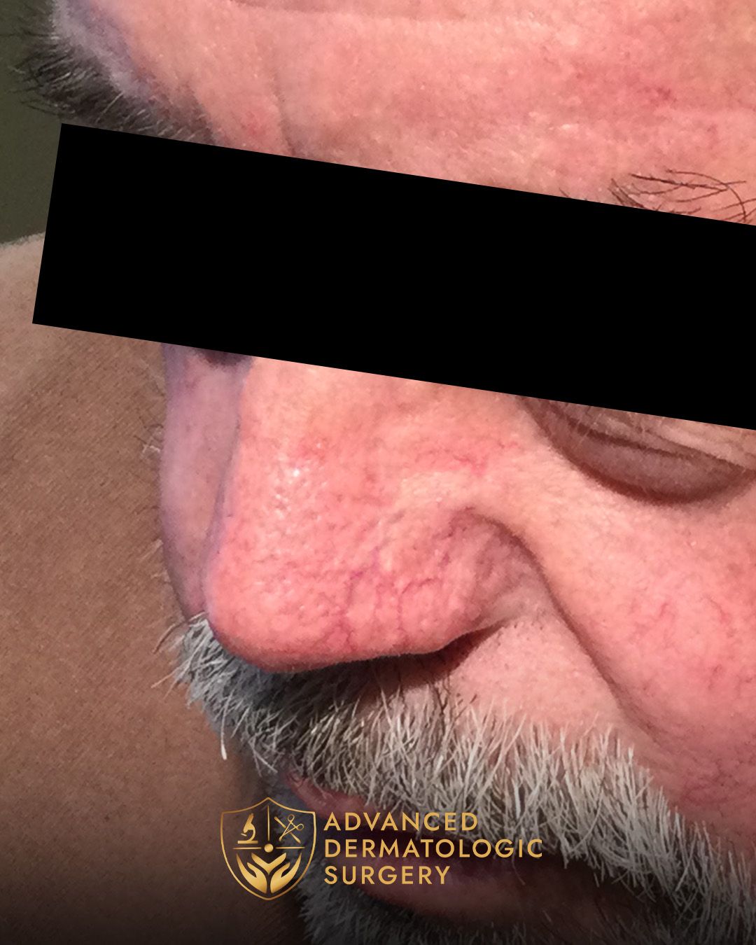 Close up of a man's nose after fully healing from surgery