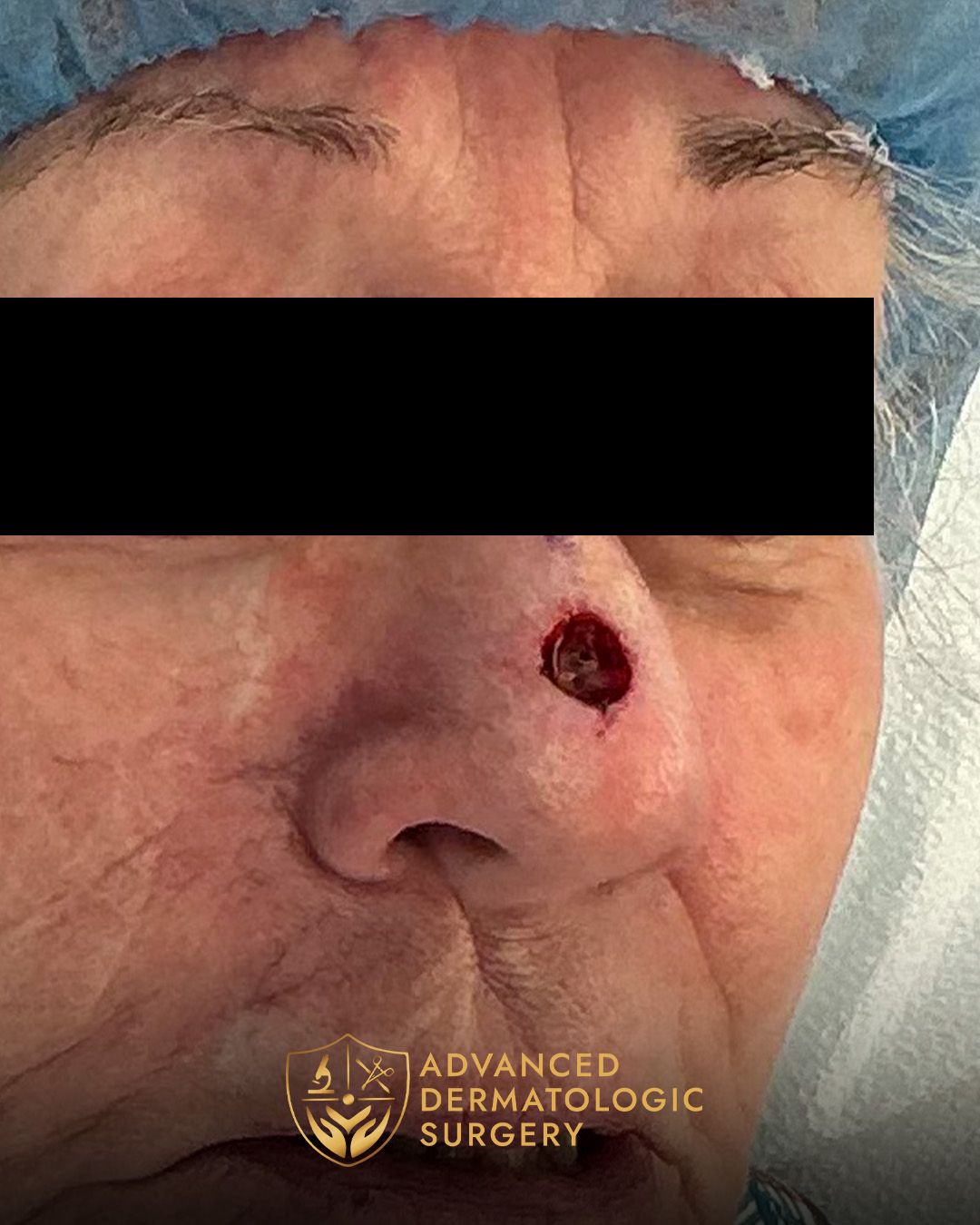 Close up of a woman's nose after Mohs surgery