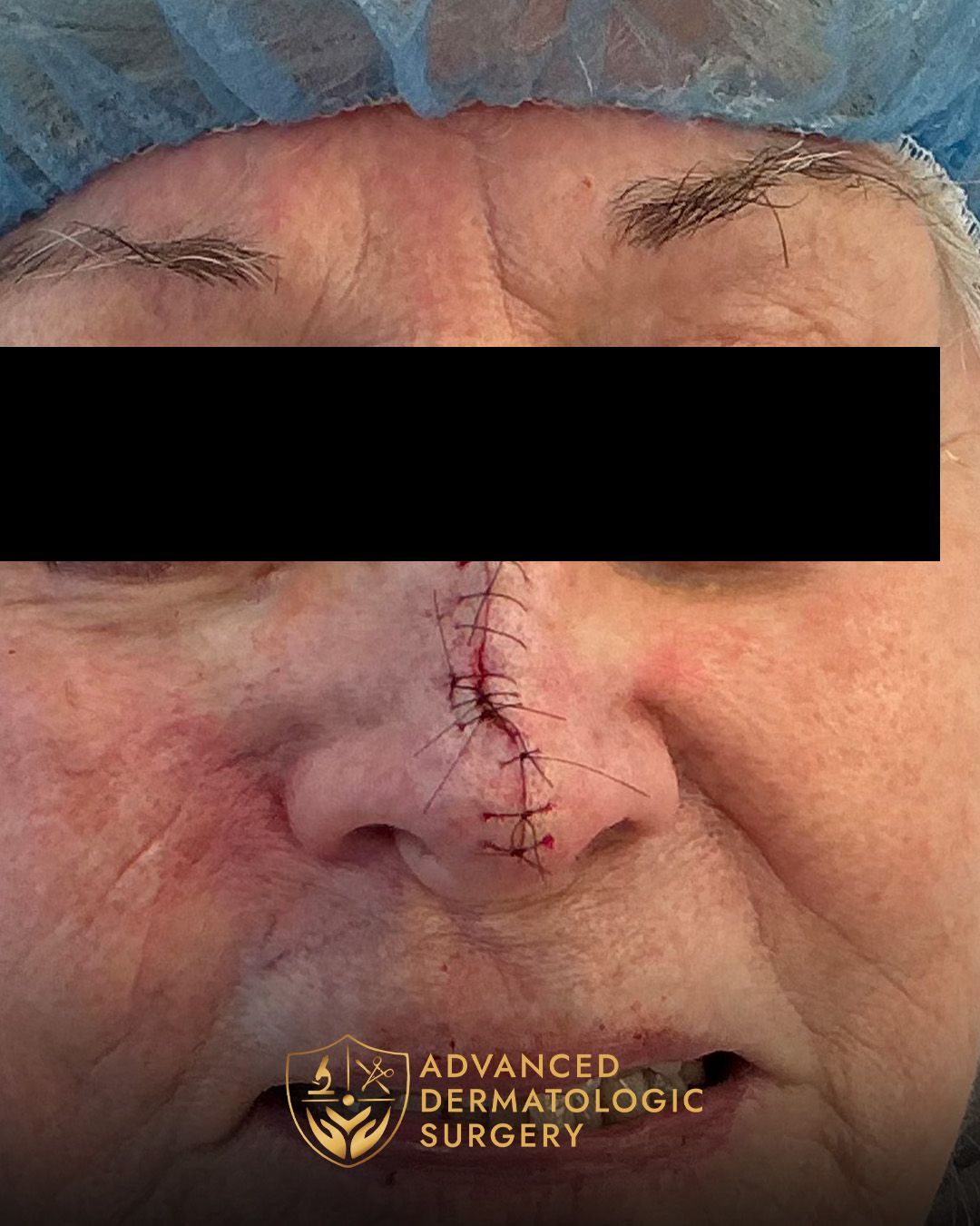 Close up of a woman's nose after reconstruction surgery