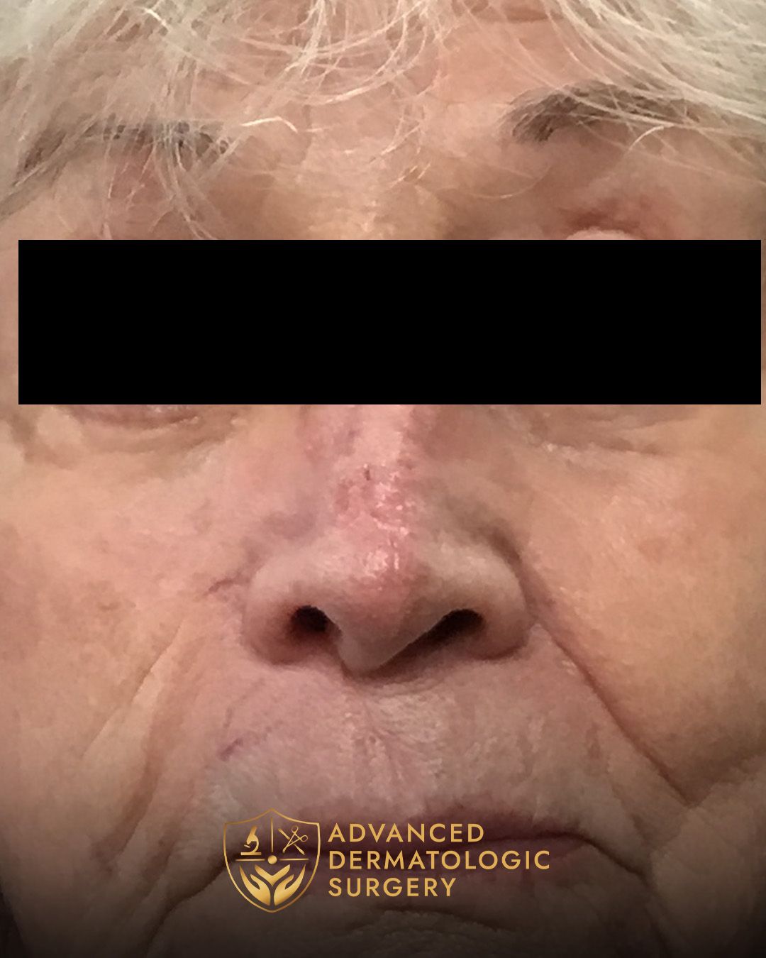 Close up of a woman's nose after fully healing