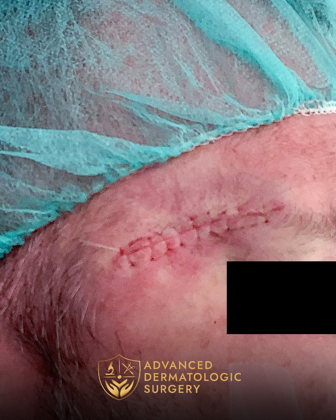 Close up of a man's temple after reconstruction surgery
