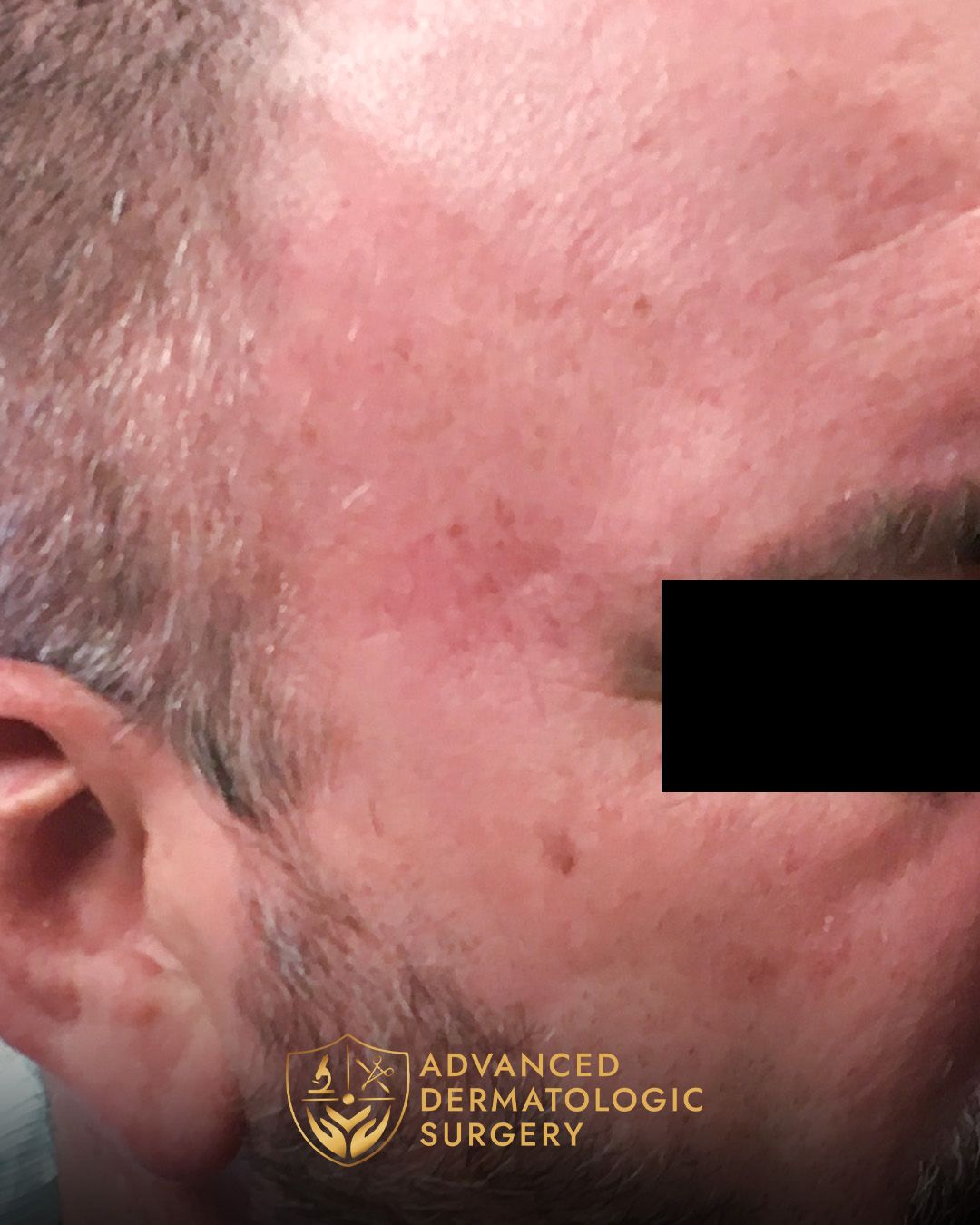 Close up of a man's temple after healing from surgery