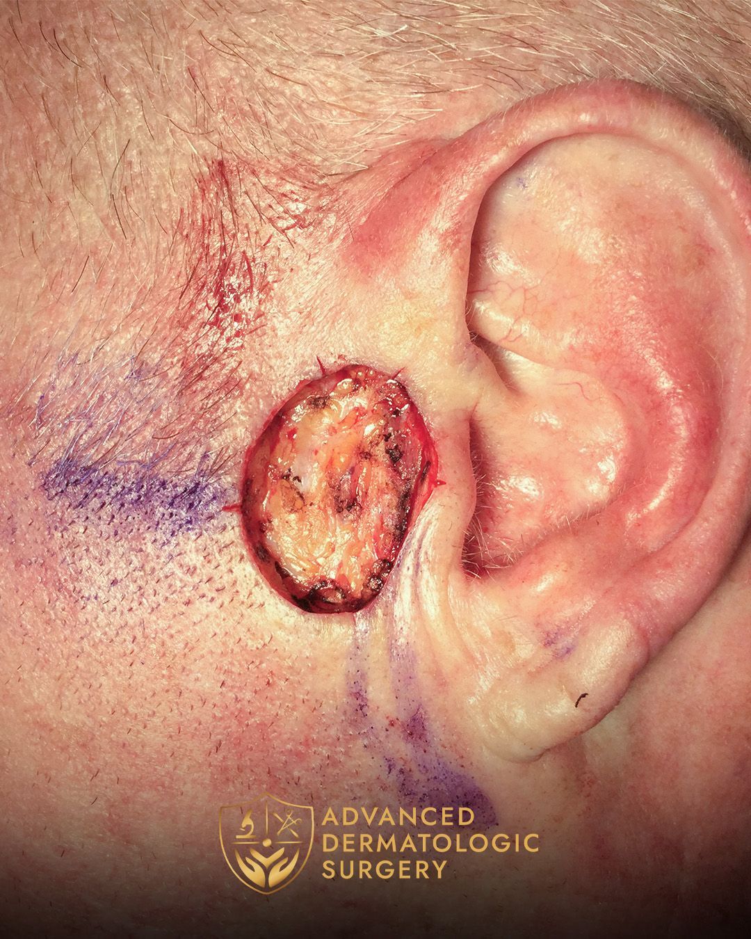Close up of a spot removal by a man's ear