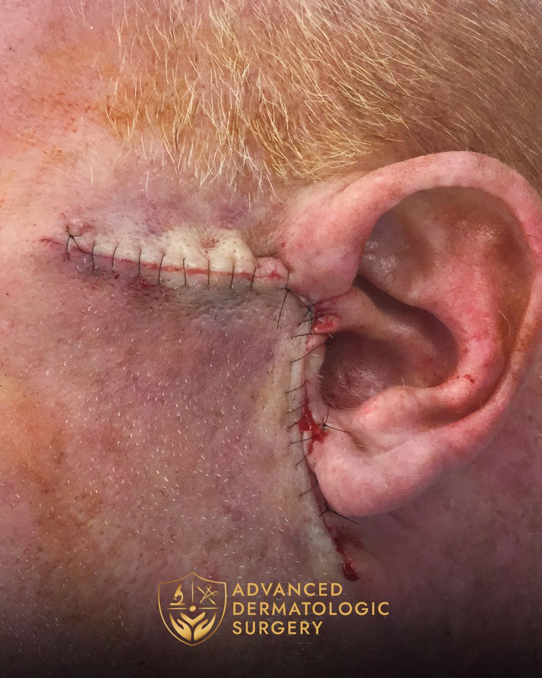 Close up of a man's ear after reconstruction surgery