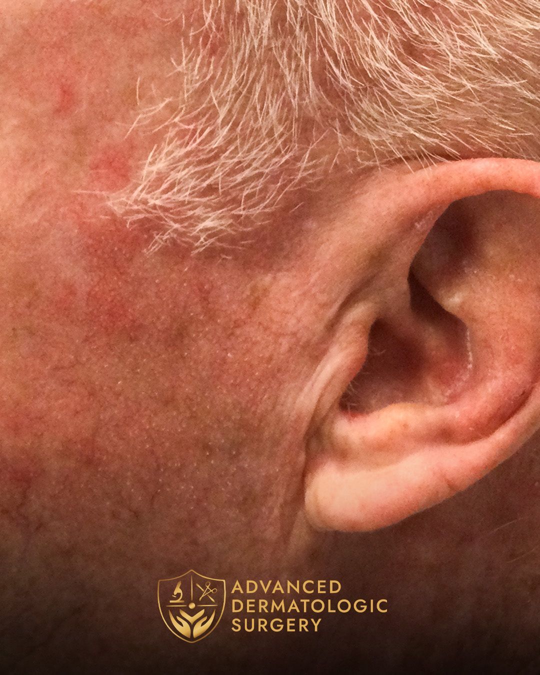 Close up of a man's ear after healing