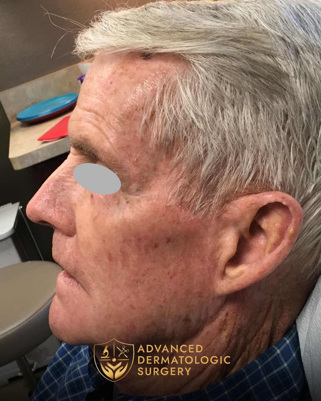 Fully healed temple of a man who underwent MOHS surgery