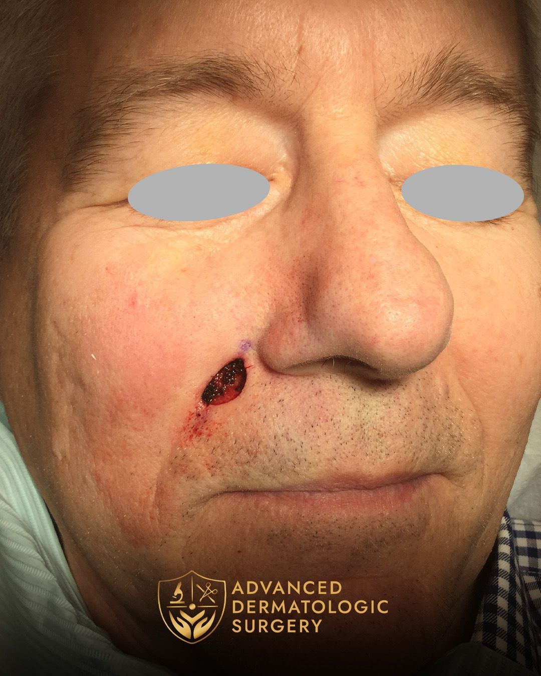 Close up of a post mohs surgery on a mans cheek