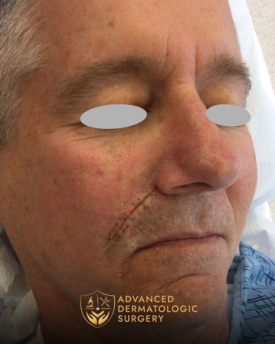 Close up of a man's cheek after reconstruction surgery