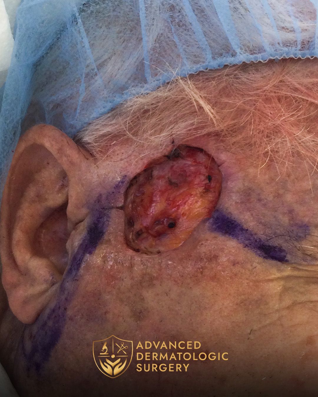 Close up of a MOHS surgery spot on the temple
