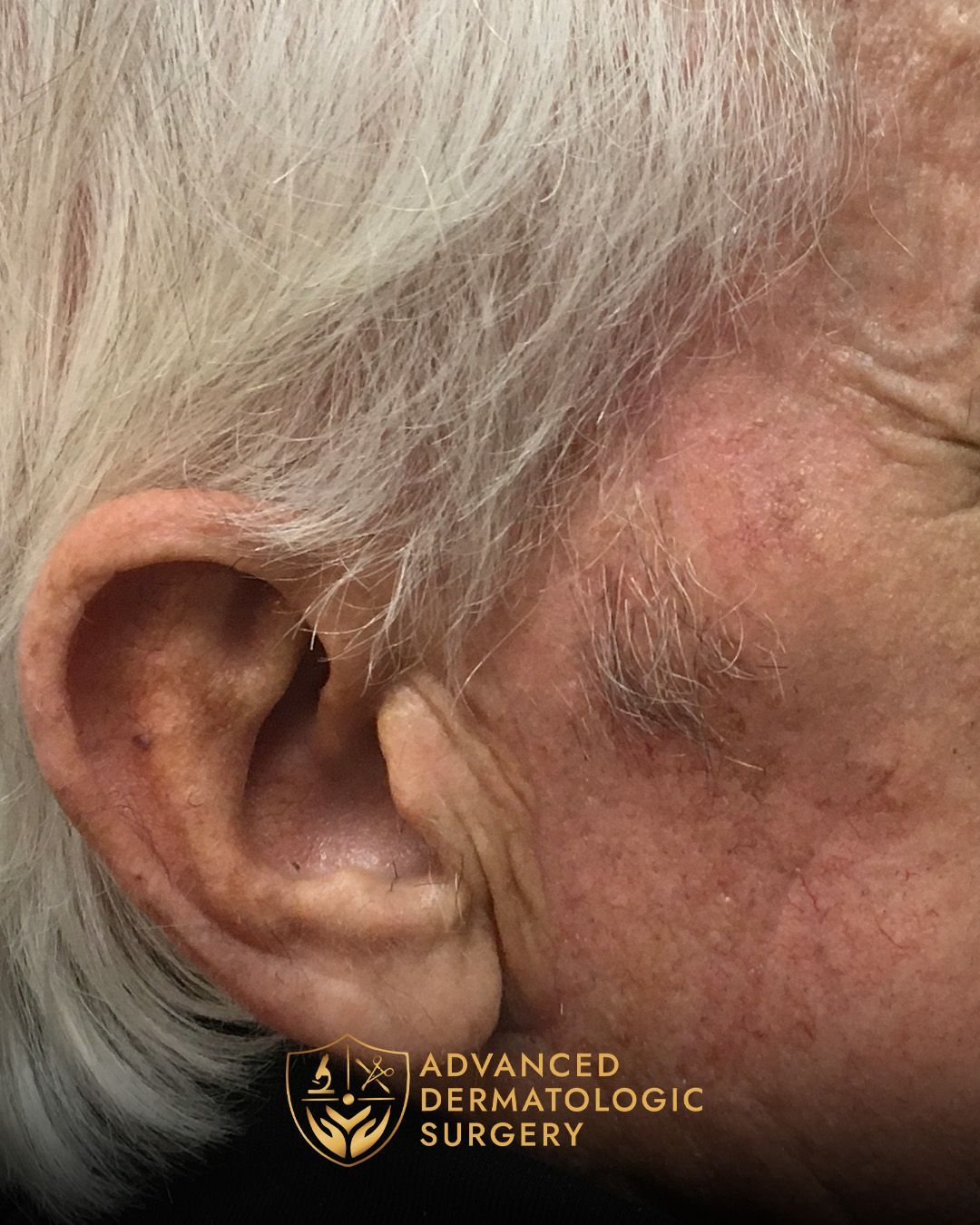 Fully healed temple of a man who underwent MOHS surgery