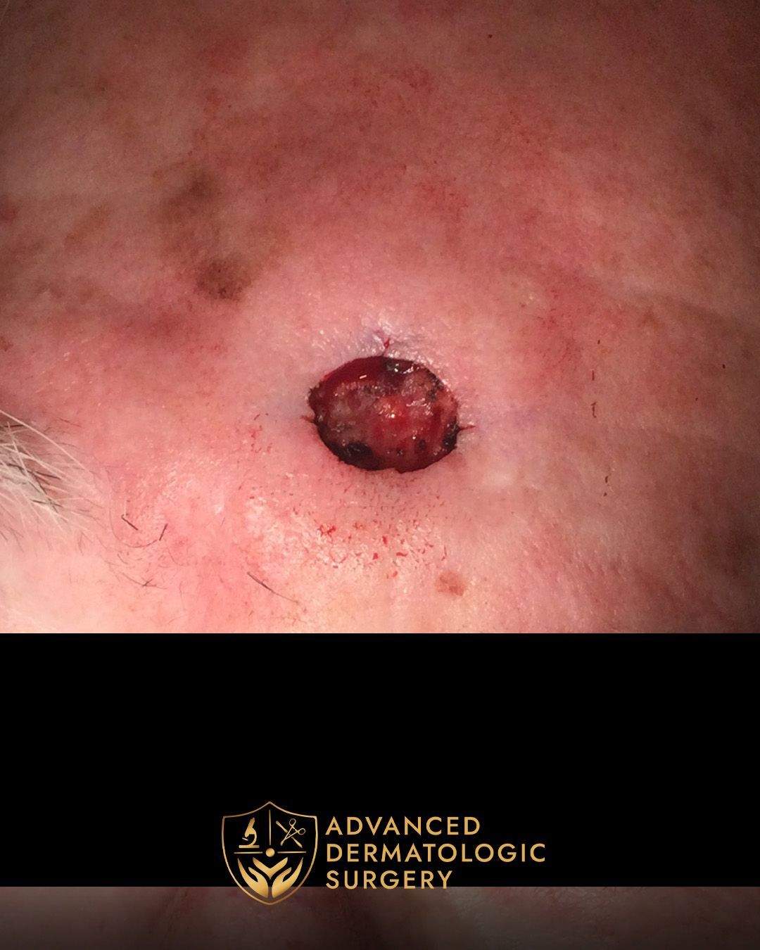 Close up of a Mohs surgery on a forehead