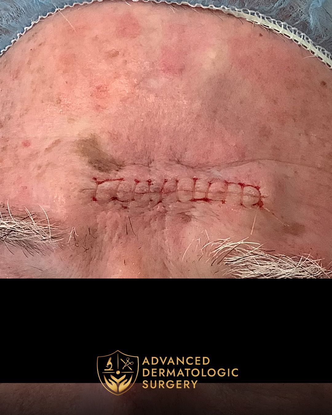 Close up of reconstruction surgery on a forehead