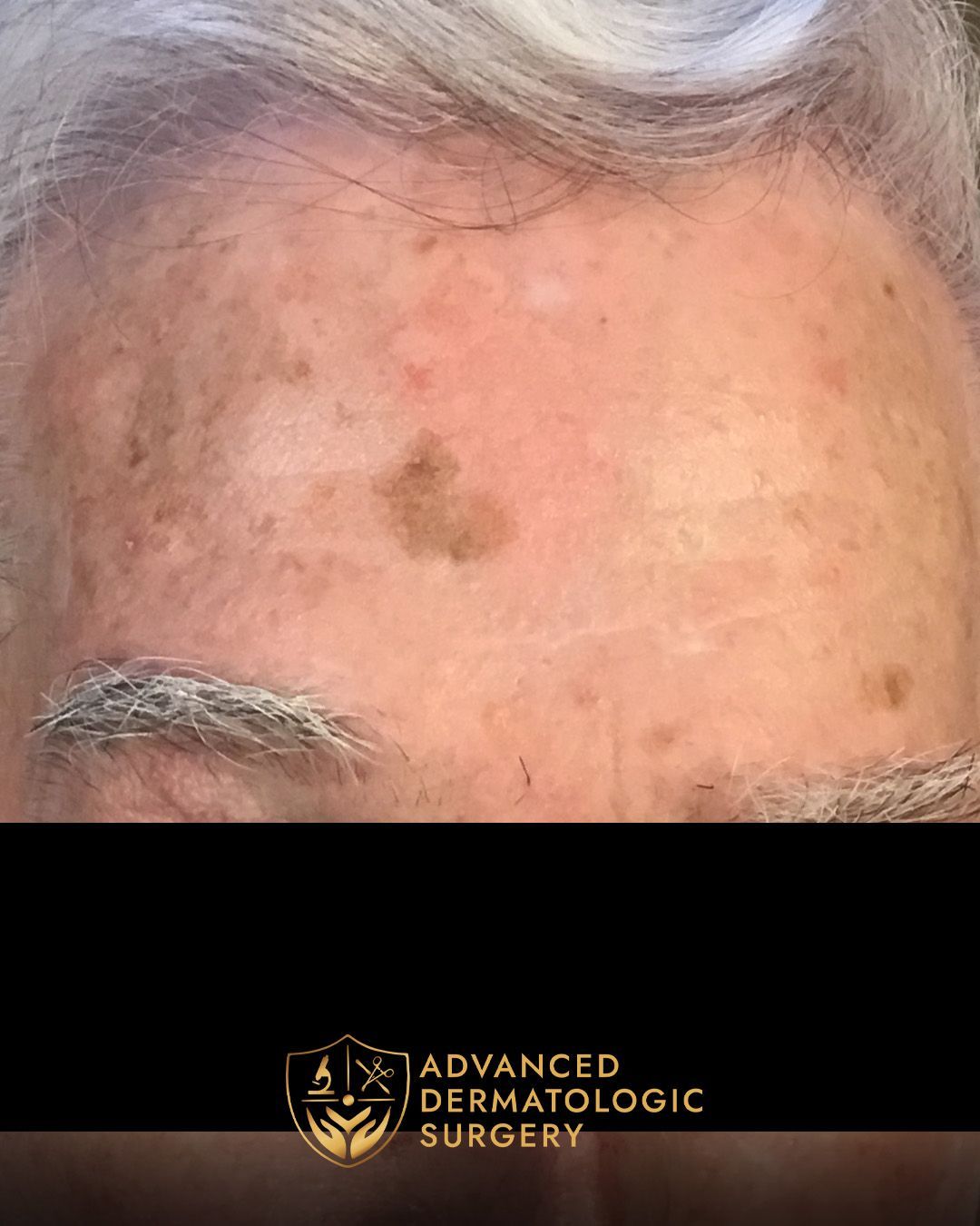 Close up of a fully healed forehead after sugery