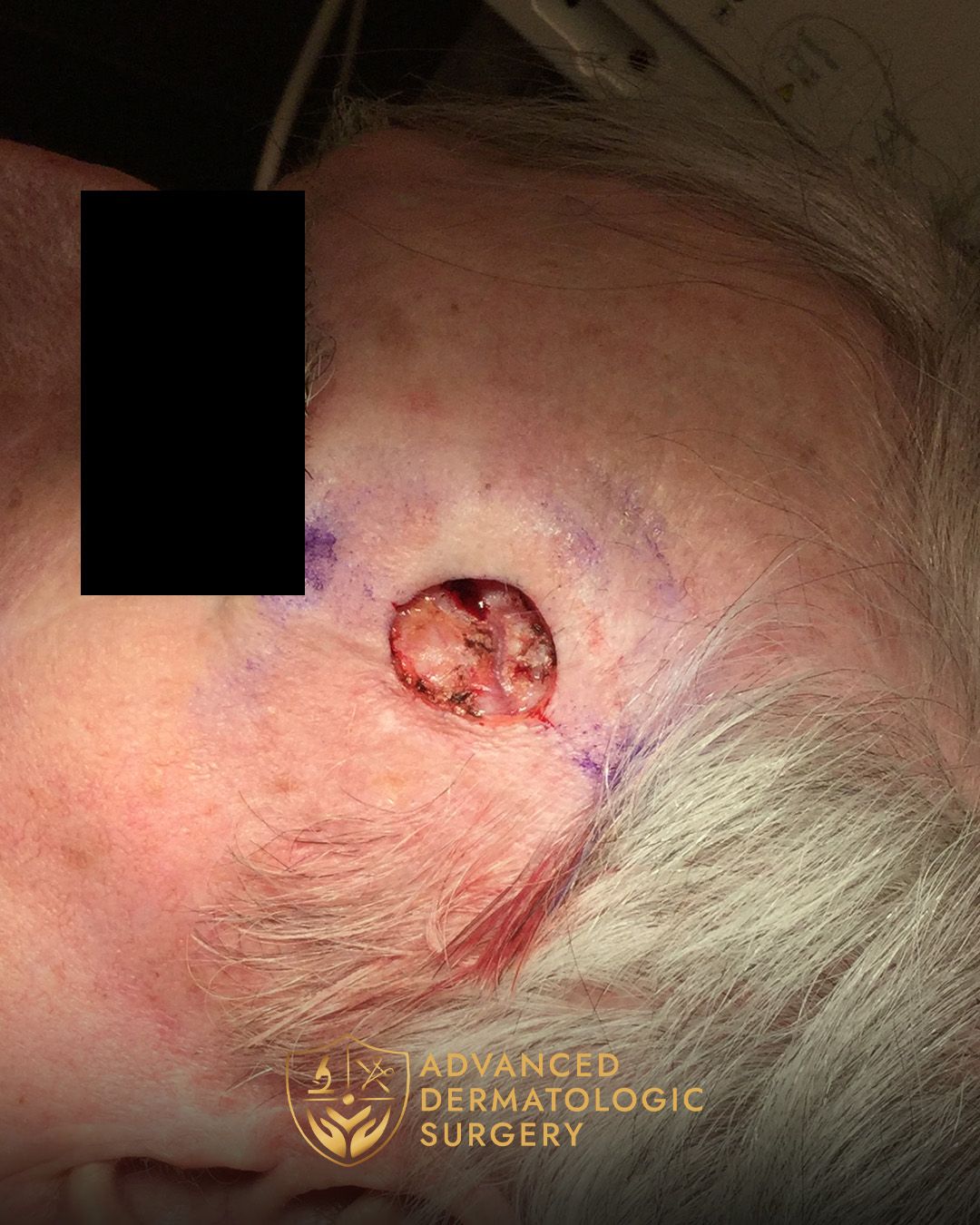 Close up of a MOHS surgery spot on the temple