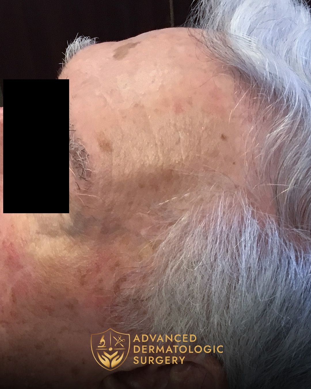 Fully healed temple of a man who underwent MOHS surgery