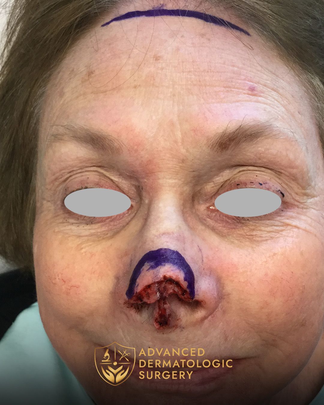 A woman underwent Mohs on her nose 