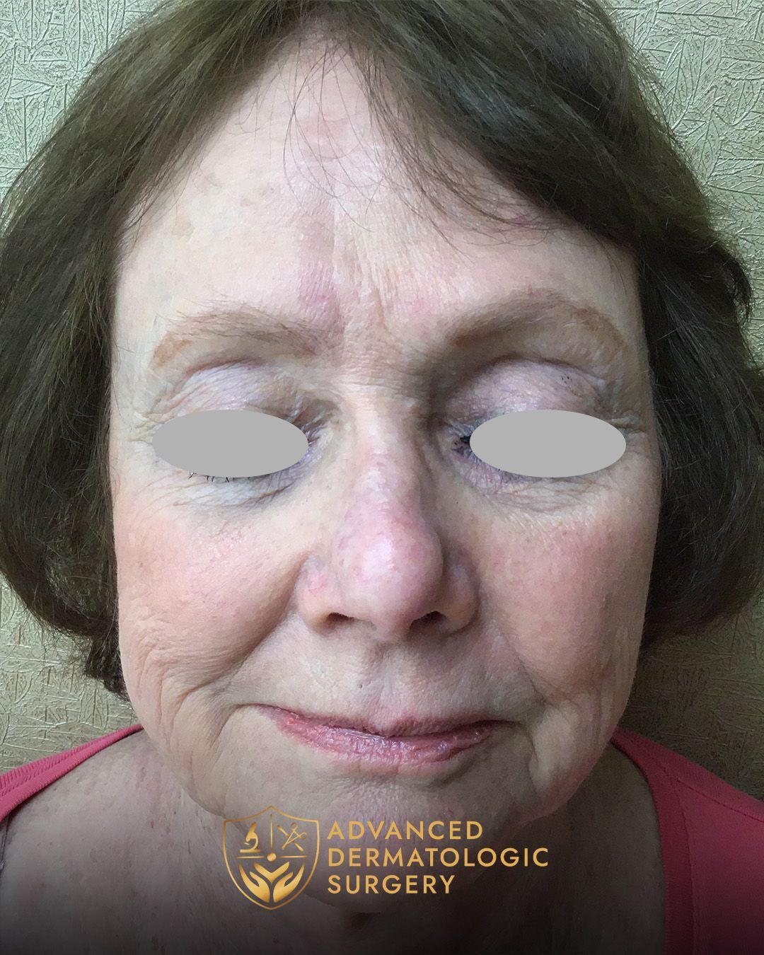 A fully healed nose and forehead surgery on a woman's face