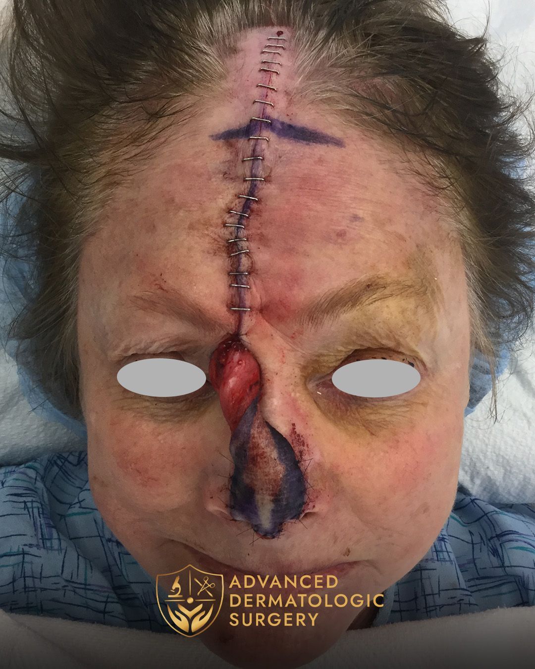 Reconstruction surgery on a woman's nose and forehead