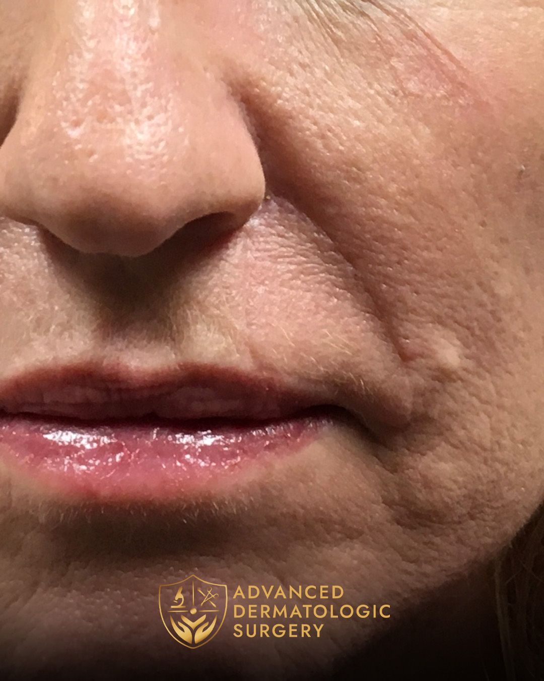 A fully healed close up of a womans mouth after surgery
