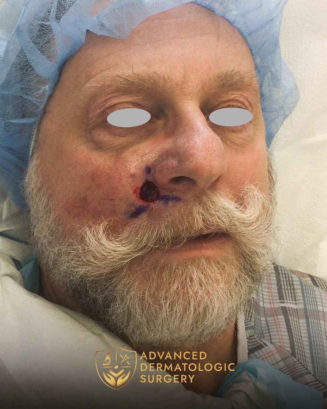 Close up of a post mohs surgery on a mans cheek