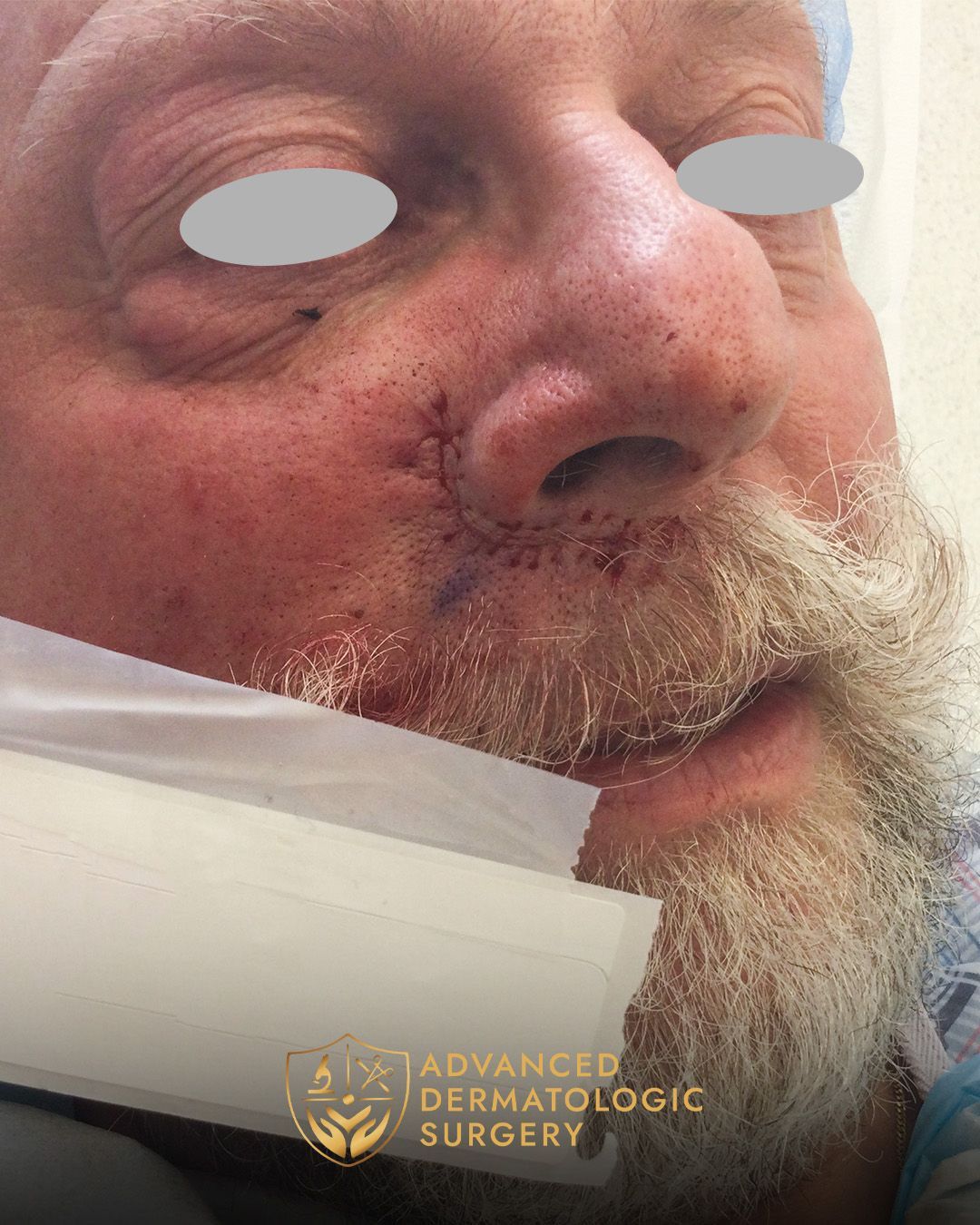 Close up of a man's cheek after reconstruction surgery