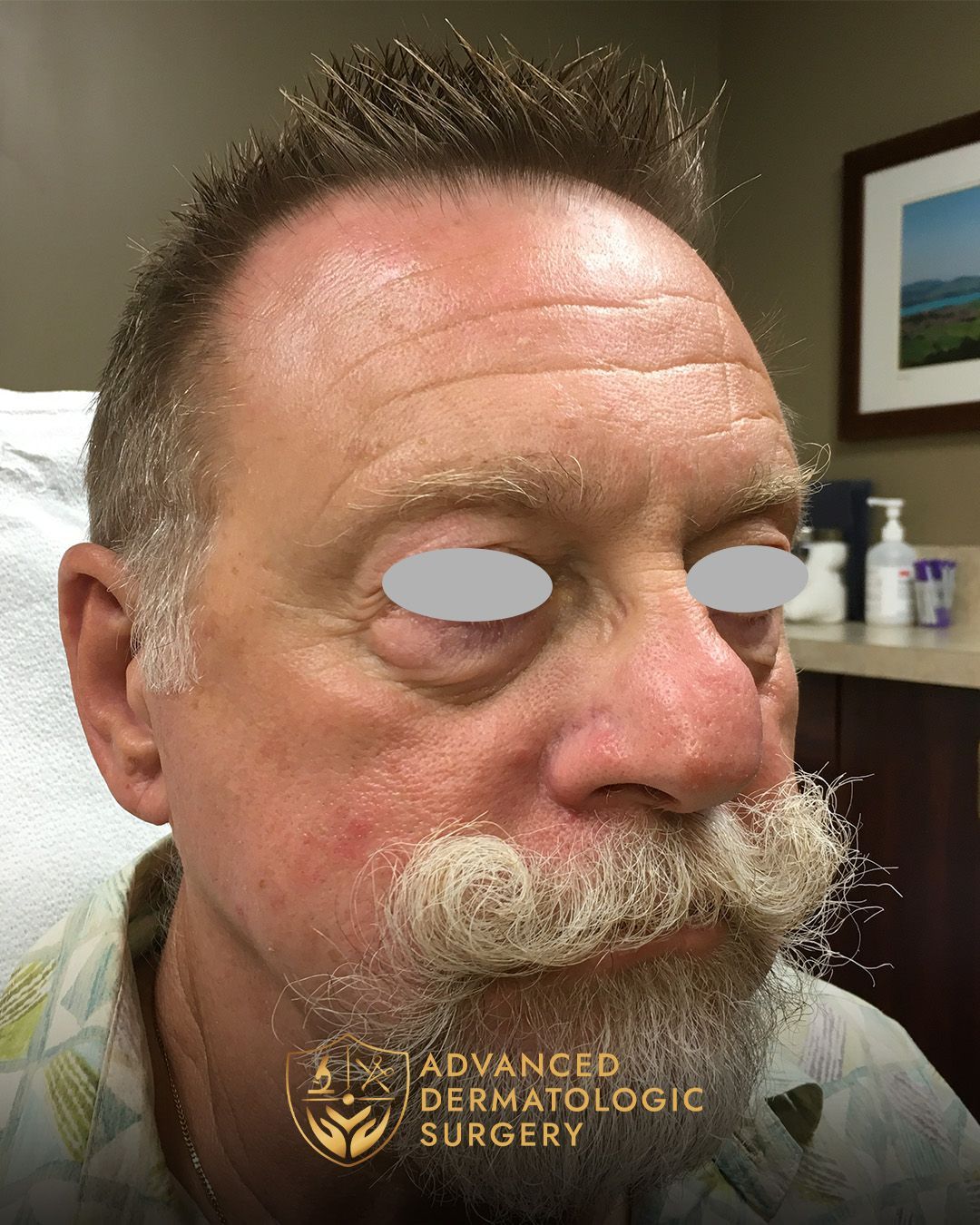 A fully healed cheek of a man that went through reconstruction surgery at Advanced Dermatologic Surgery