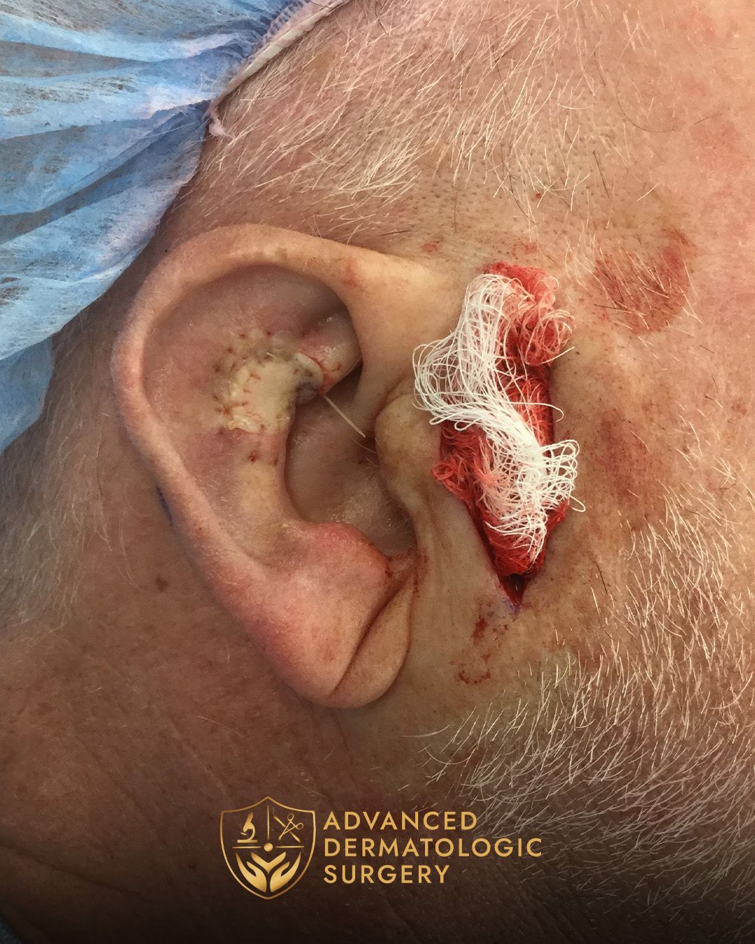 Close up of a man's ear after reconstruction surgery at Advanced Dermatologic Surgery