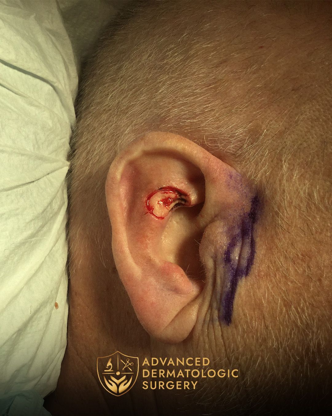 Close up of a spot Mohs removal by a man's ear done at Advanced Dermatologic Surgery