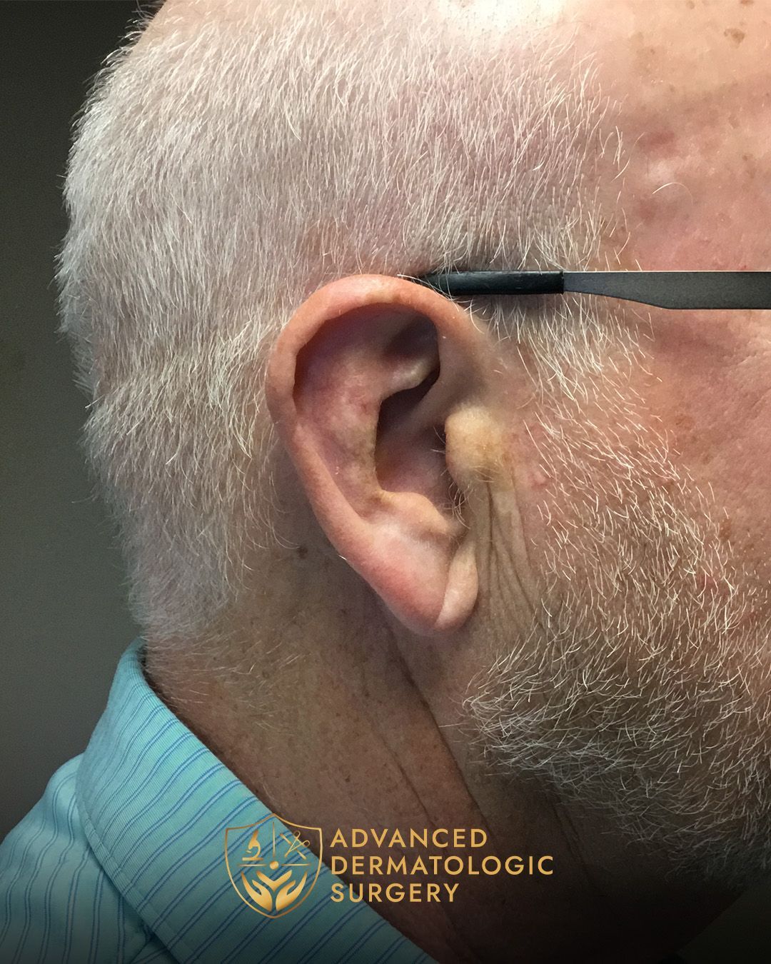 Close up of a man's ear after healing