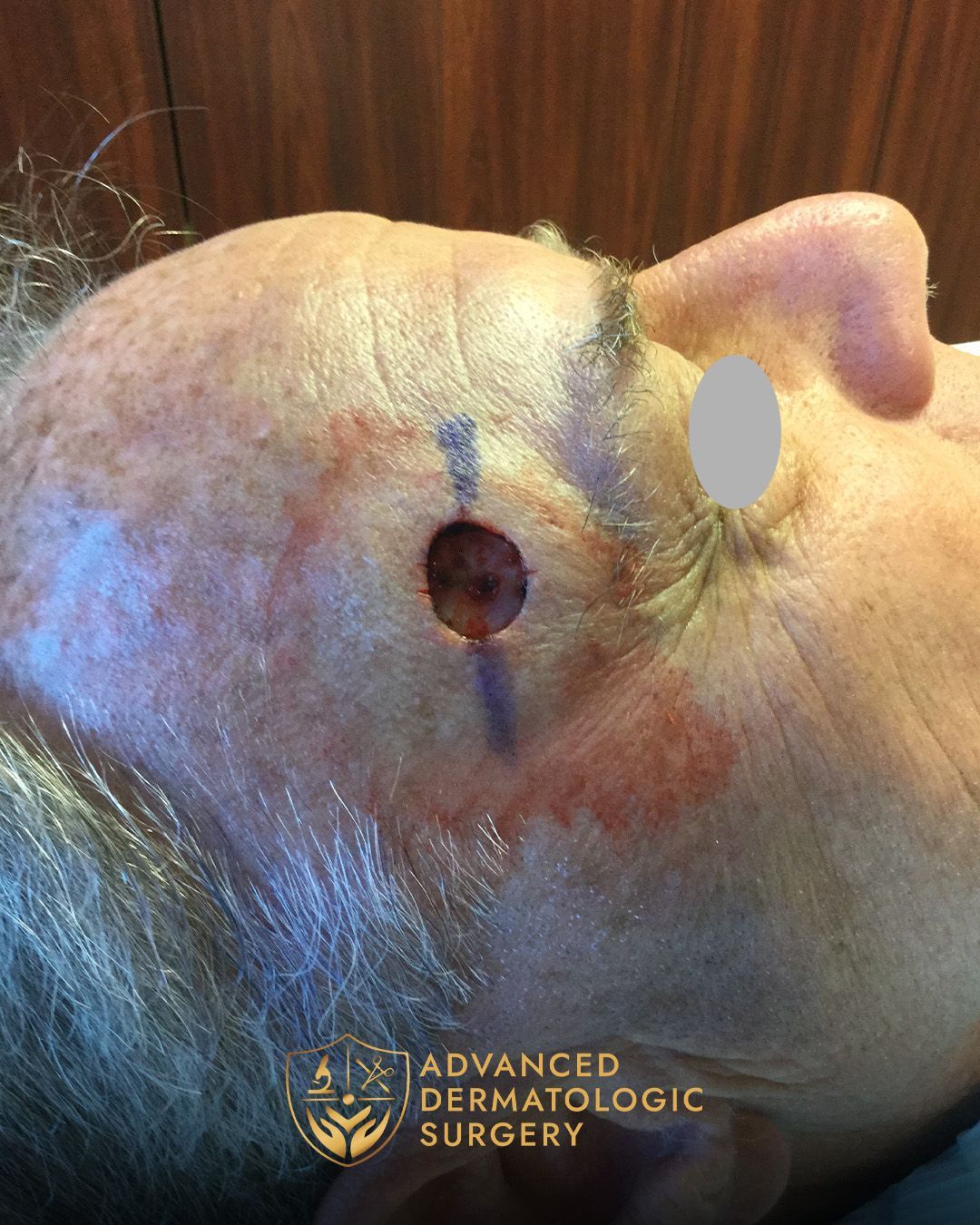 Close up of a Mohs surgery on a forehead at Advanced Dermatologic Surgery