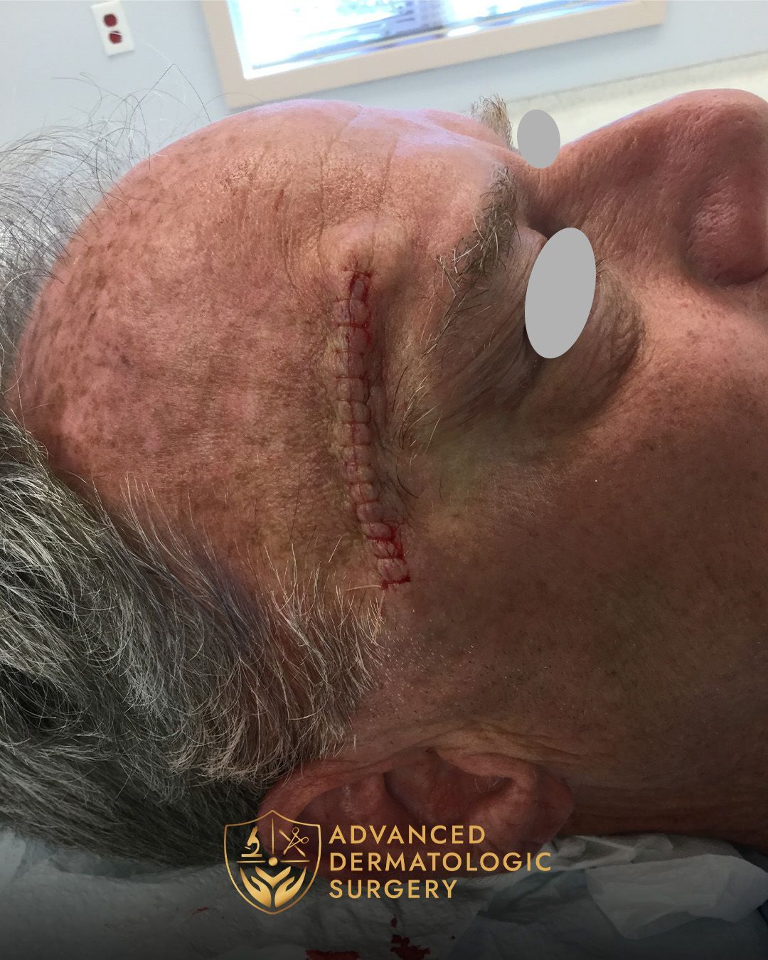 Close up of reconstruction surgery on a man's forehead at Advanced Dermatologic Surgery