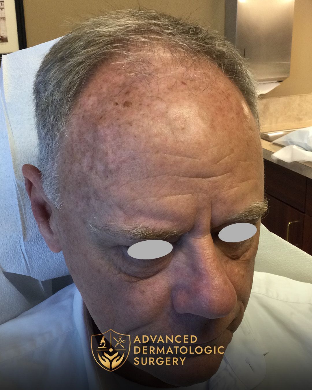Close up of a fully healed forehead after sugery