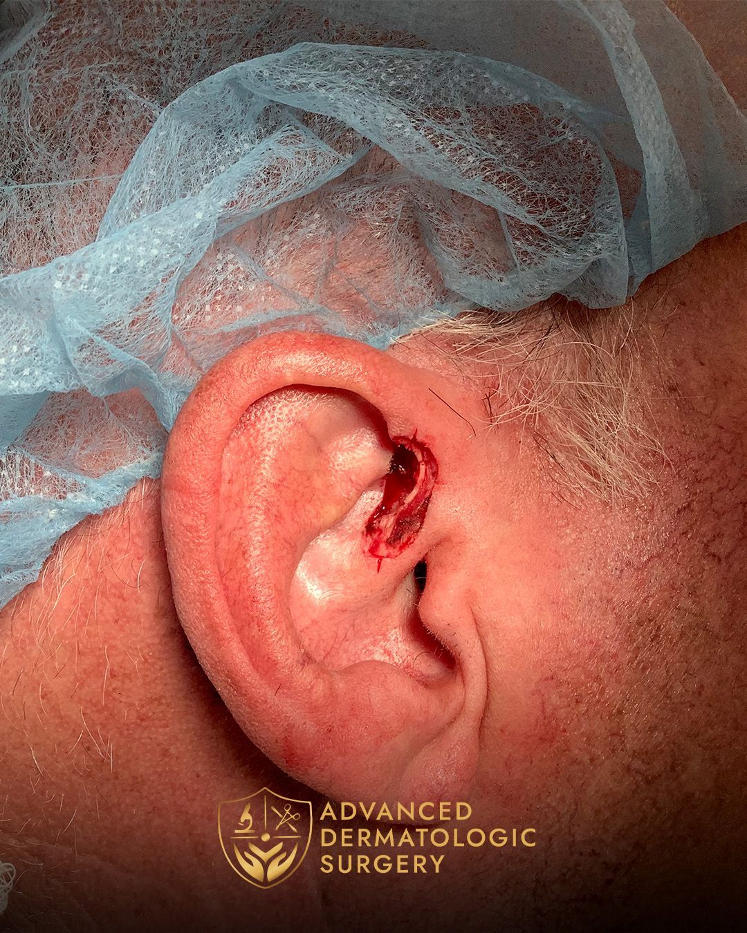 Close up of a spot Mohs removal by a man's ear done at Advanced Dermatologic Surgery