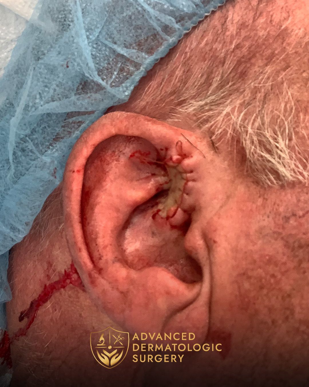 Close up of a man's ear after reconstruction surgery at Advanced Dermatologic Surgery