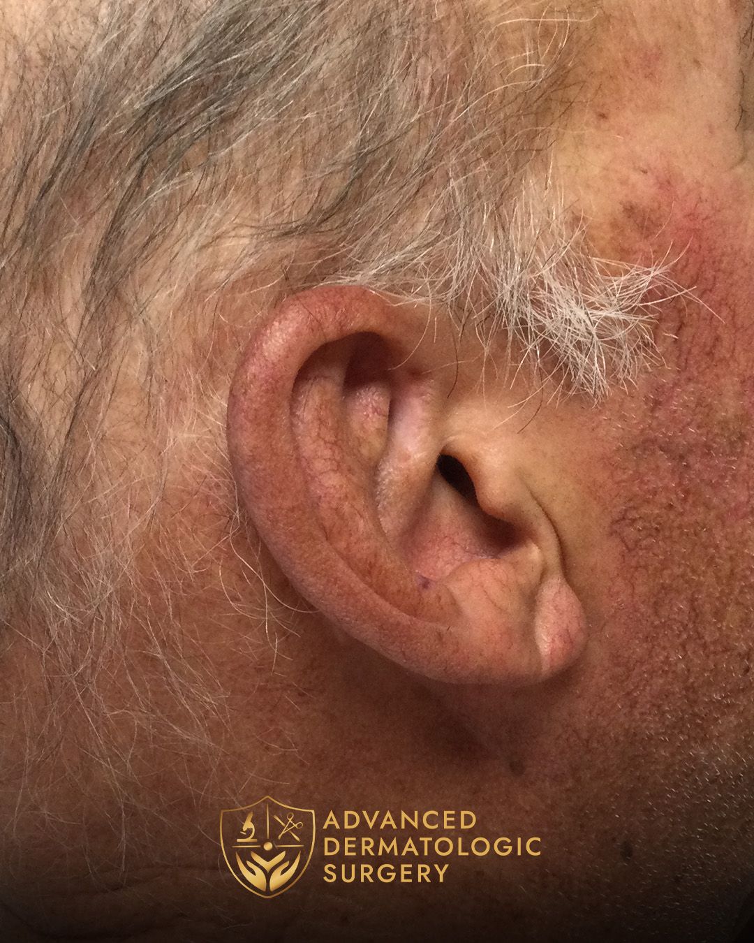Close up of a man's ear after healing