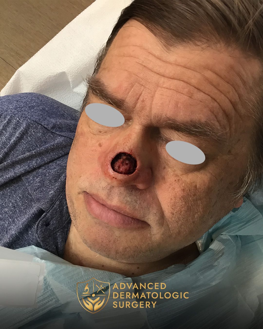 A man underwent Mohs surgery at Advanced Dermatologic Surgery