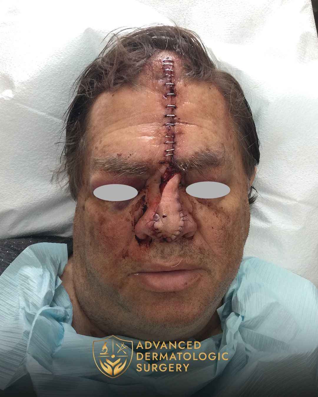 Reconstruction surgery on the nose and forehead at Advanced Dermatologic Surgery