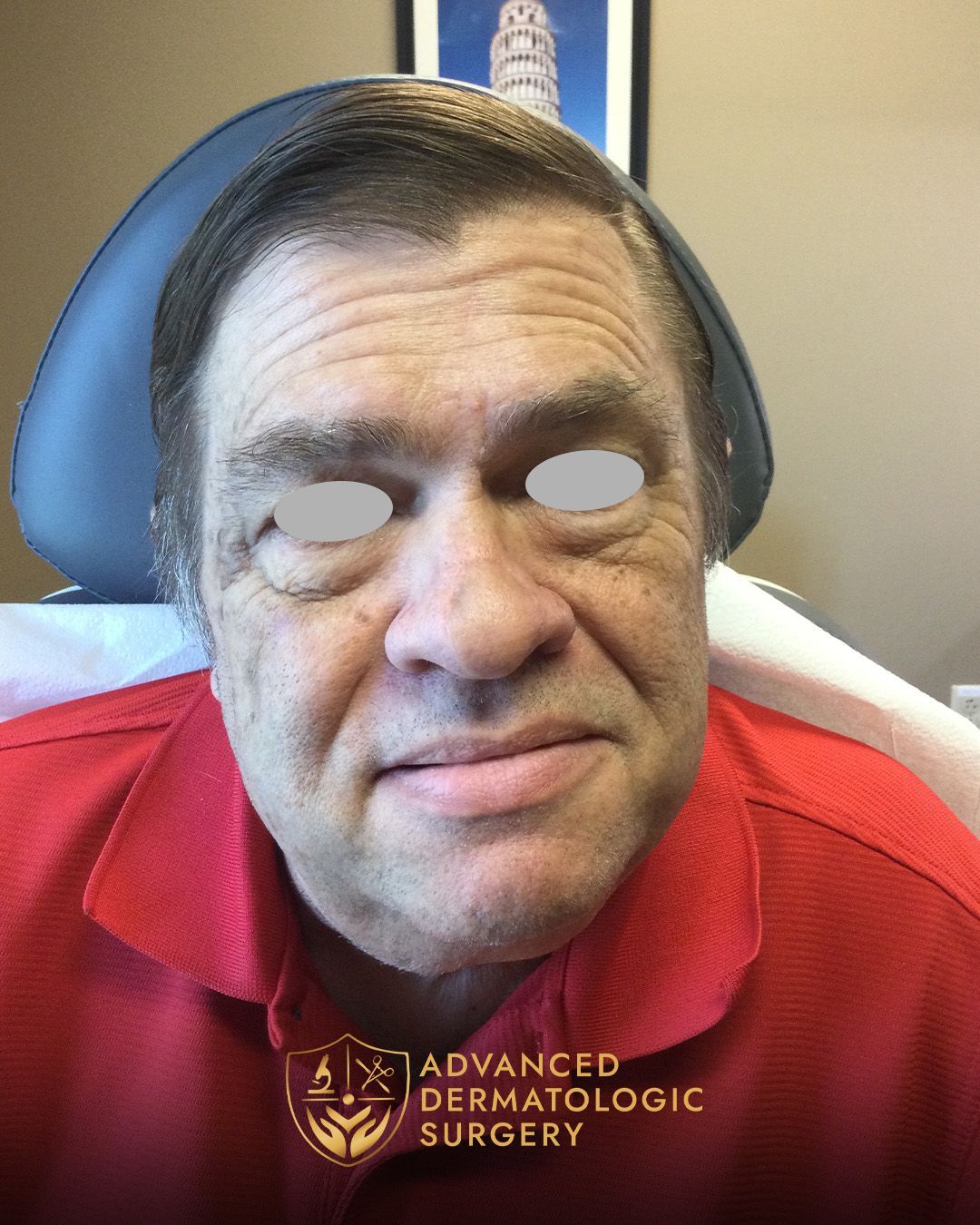 Fully healed results of a man's nose after reconstruction surgery