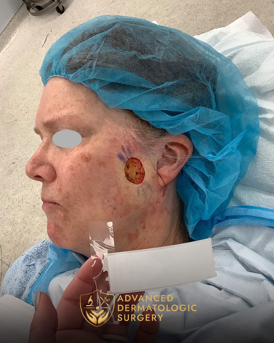 Close up of a woman's face who received a MOHS surgery on her cheek at Advanced Dermatologic Surgery