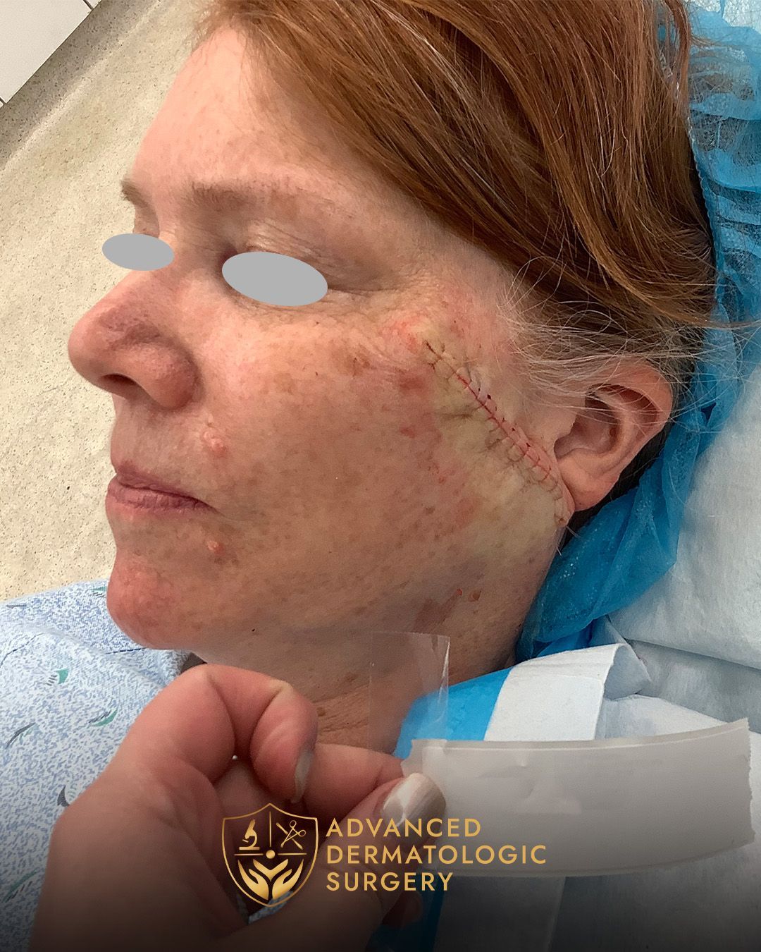 Close up of a woman's cheek after reconstruction at Advanced Dermatologic Surgery